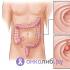 Полипы в кишечнике: признаки, симптомы, лечение у взрослых Как узнать полипы в кишечнике